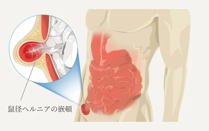 小児鼠径ヘルニアの早期治療の重要性