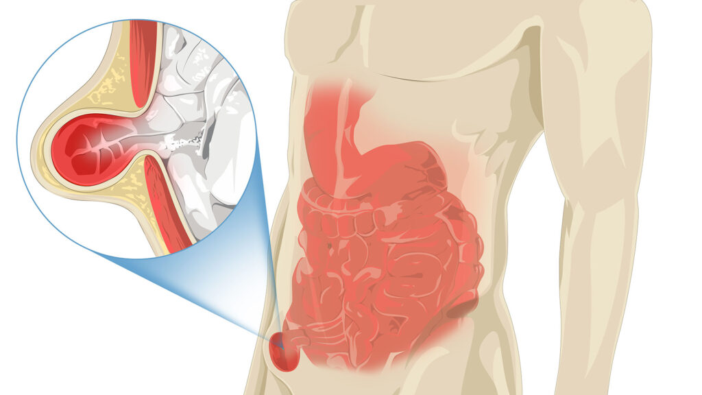鼠径ヘルニアの嵌頓