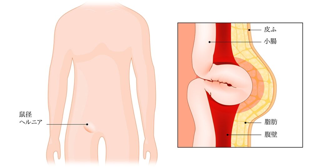 鼠径ヘルニア