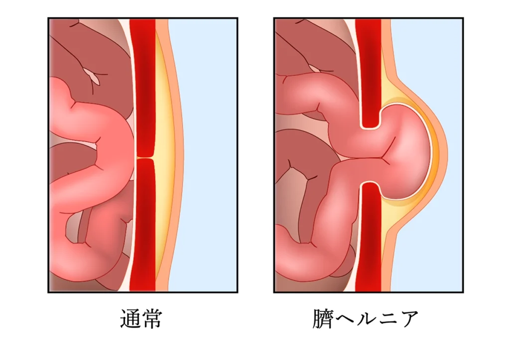 臍ヘルニア