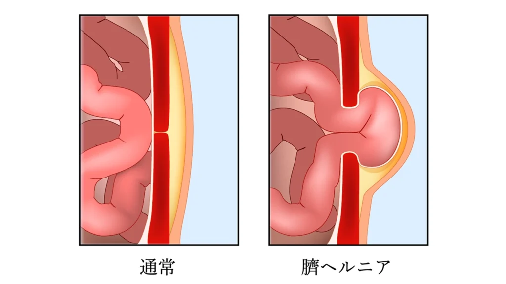 臍ヘルニア