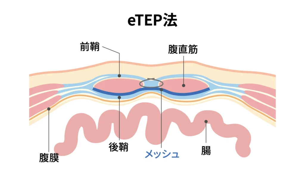 eTEP法