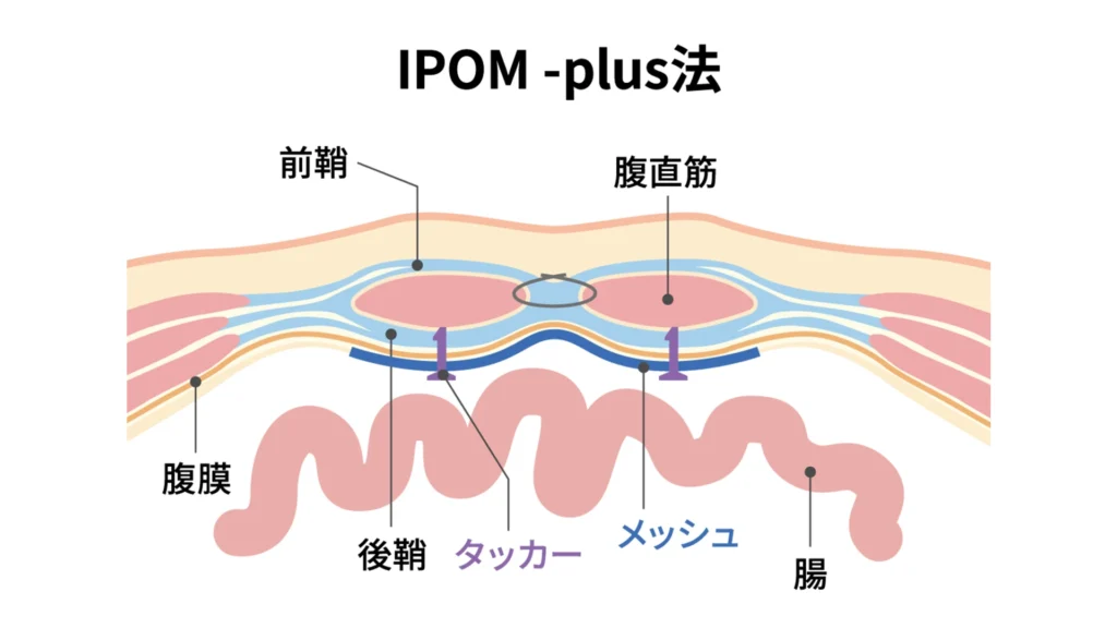 IPOM-plus法