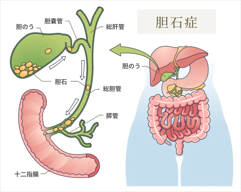 胆石症