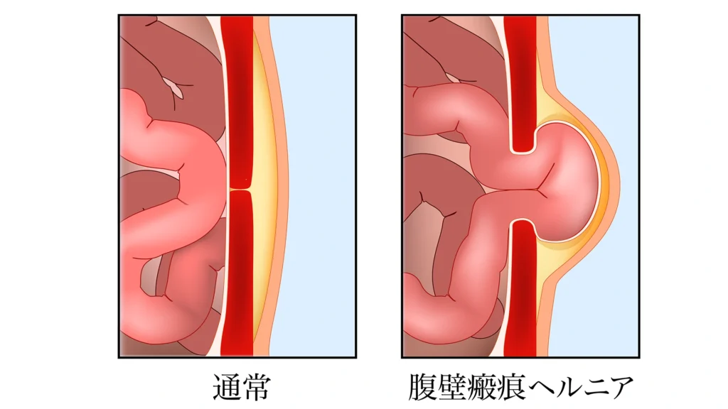 腹壁瘢痕ヘルニア
