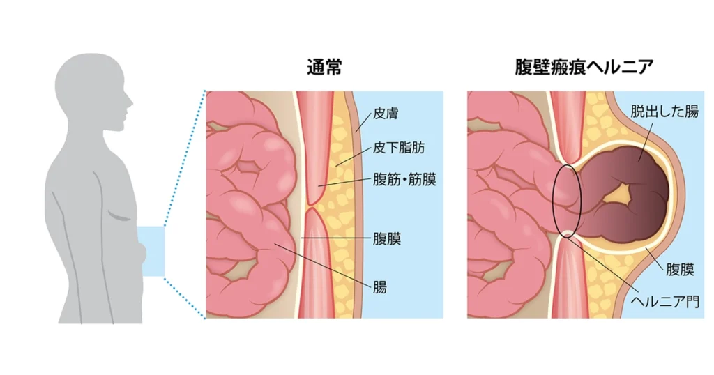 腹壁瘢痕ヘルニア
